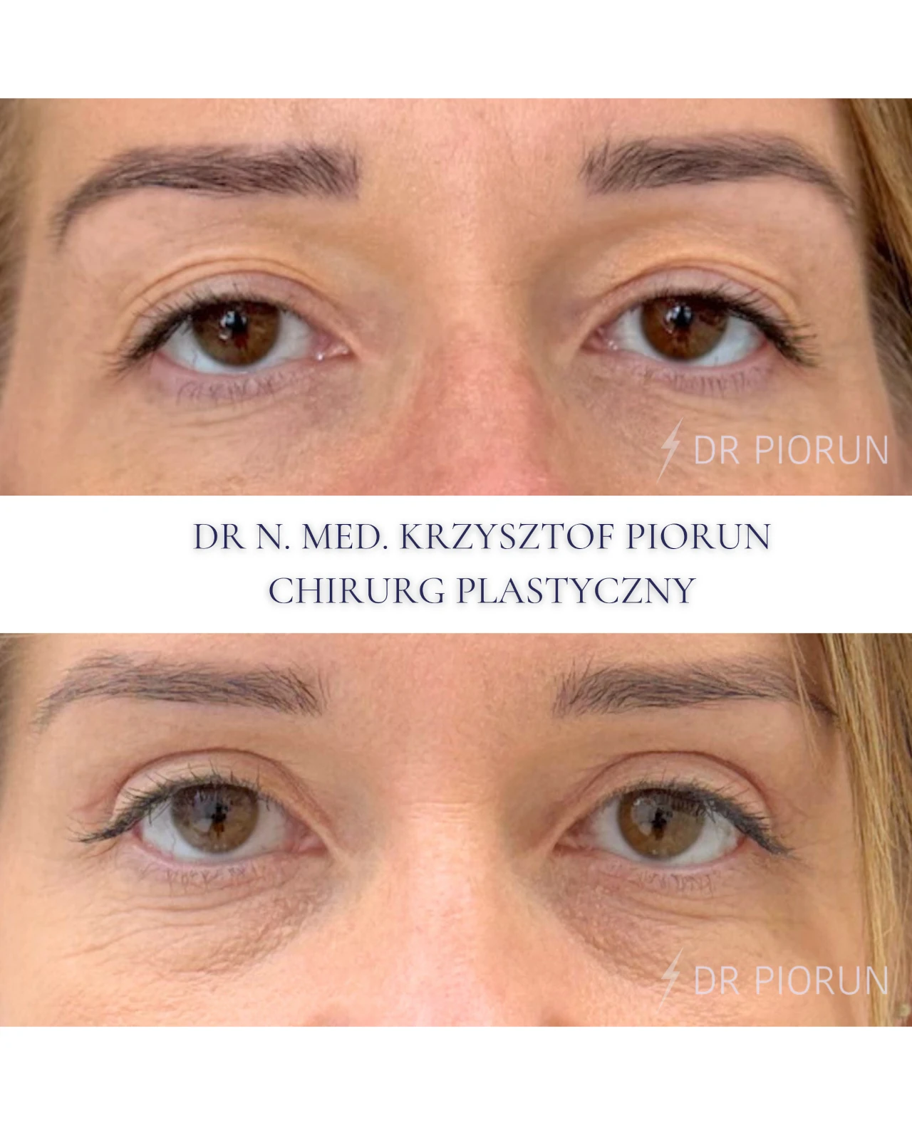 Plastyka powiek górne powieki przed zabiegiem i po