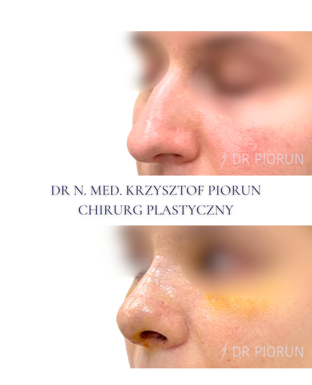 Plastyka nosa nos przed i po zabiegu