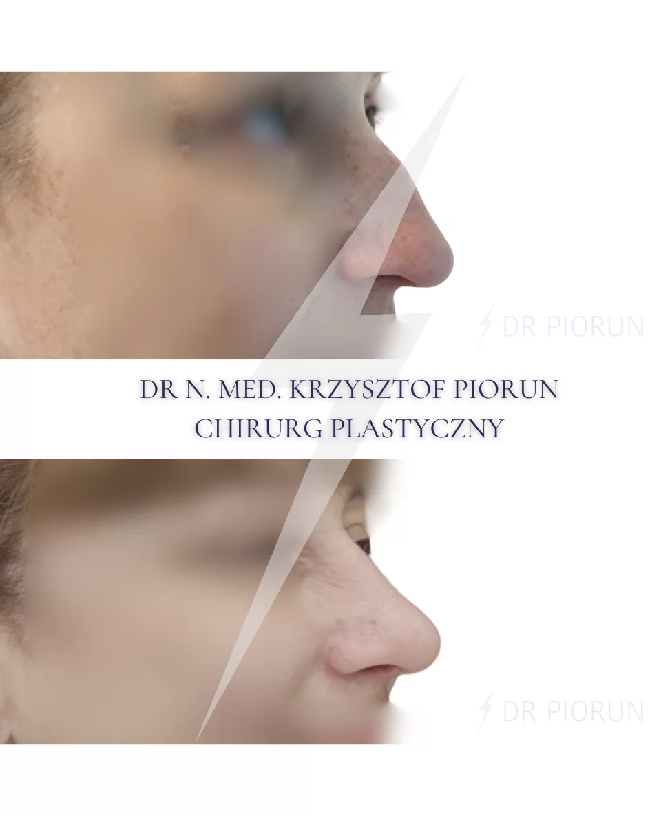 Plastyka nosa Nos przed plastyką i po