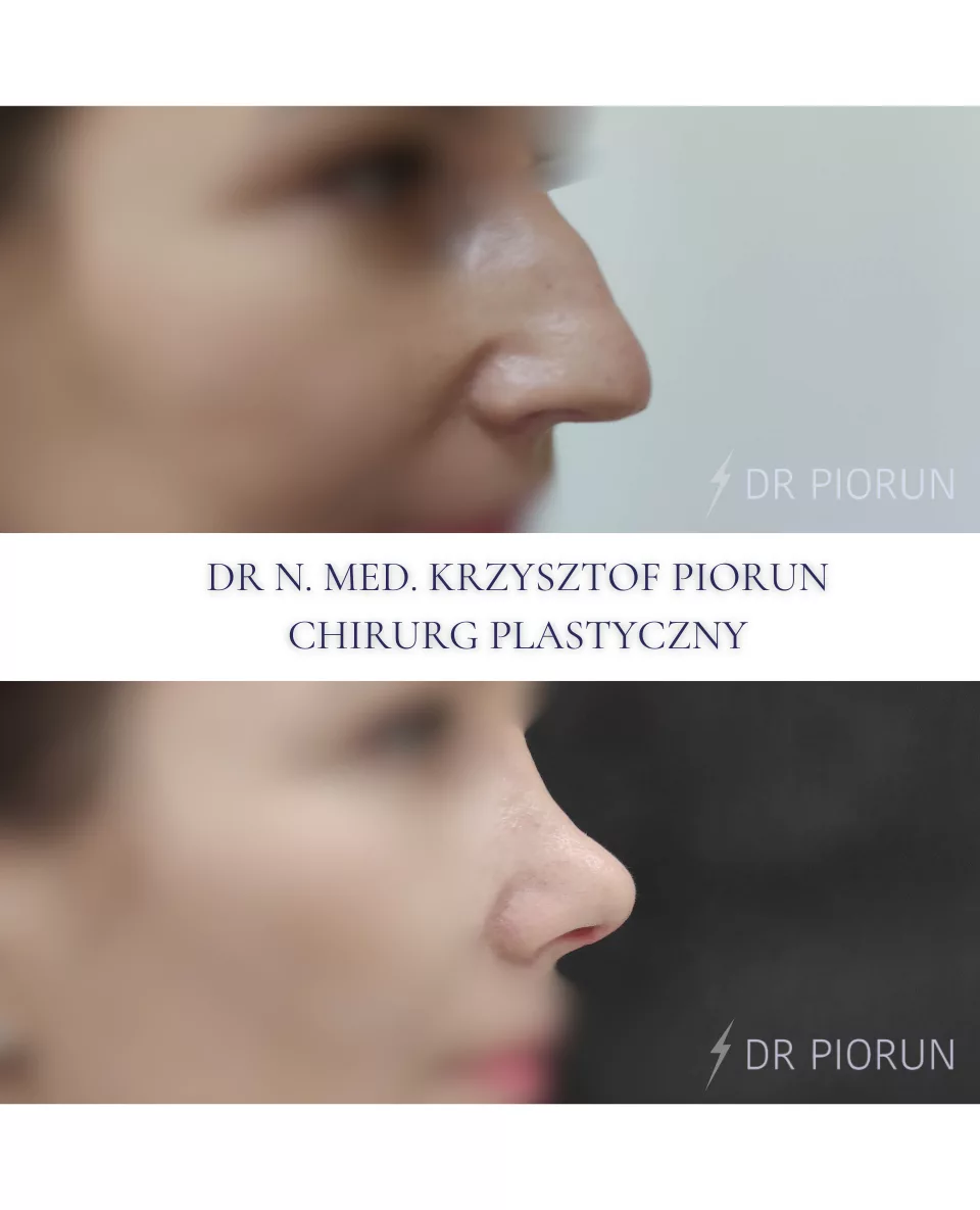 Plastyka nosa Nos przed plastyką i po
