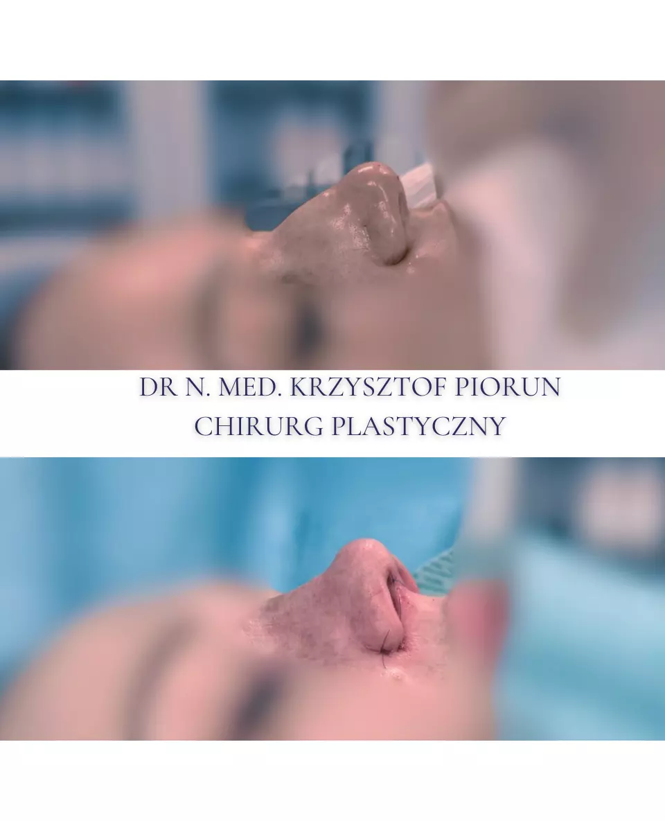 Plastyka nosa Nos przed plastyką i po