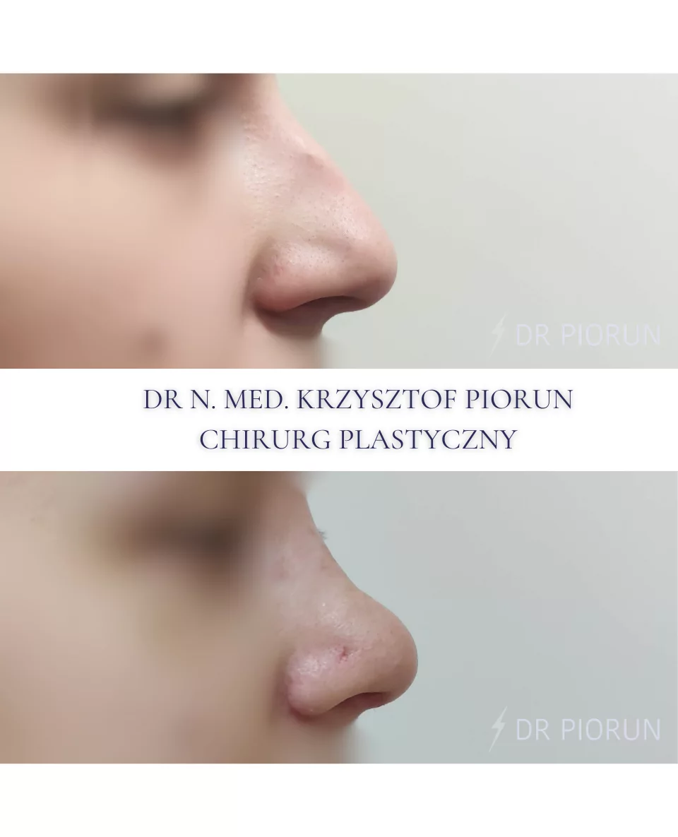 Plastyka nosa Nos przed plastyką i po
