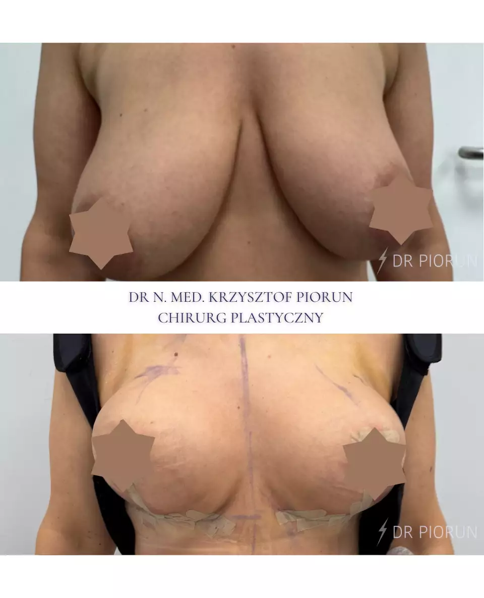 Lift piersi Piersi przed liftem i po