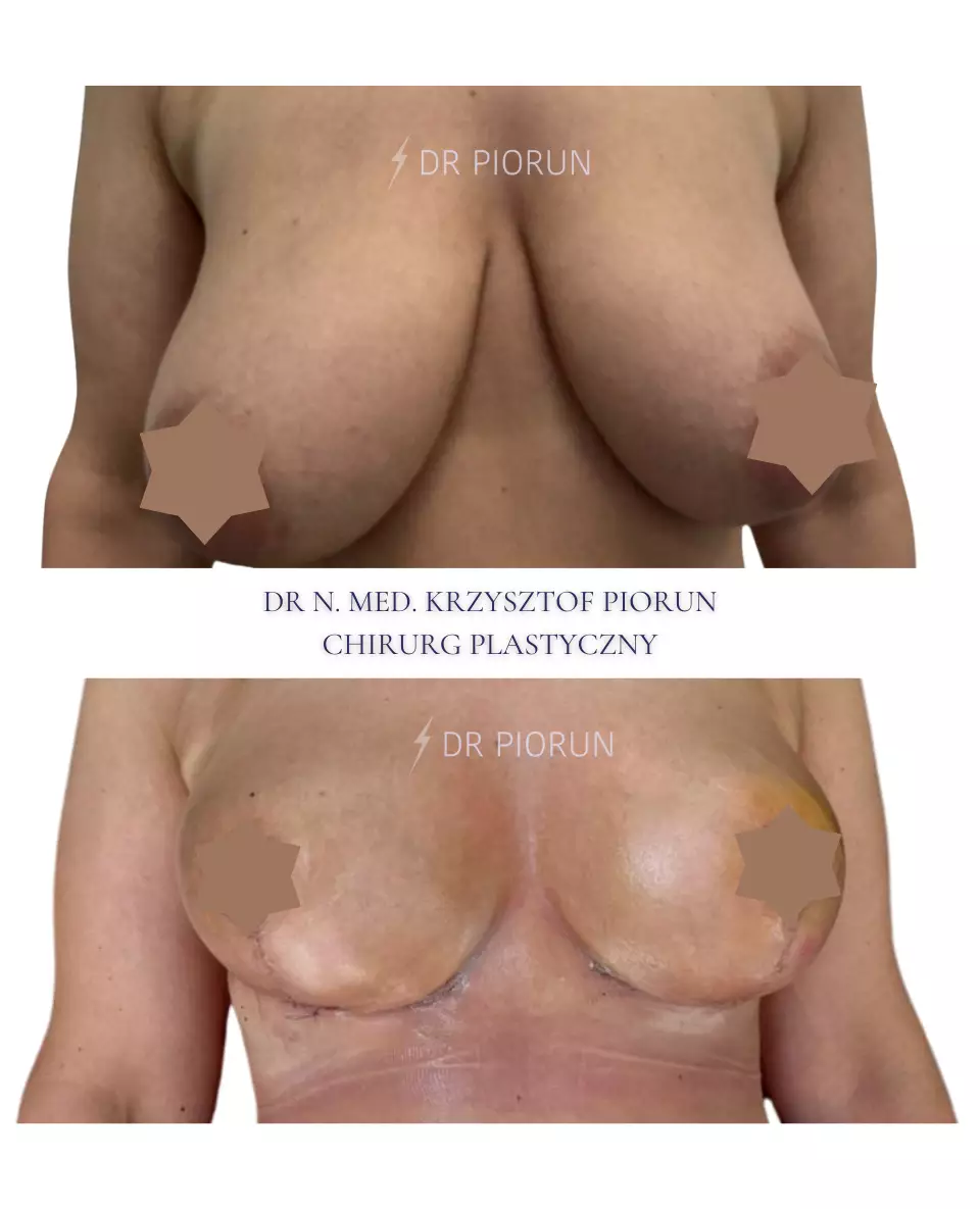 Lift piersi Piersi przed liftem i po