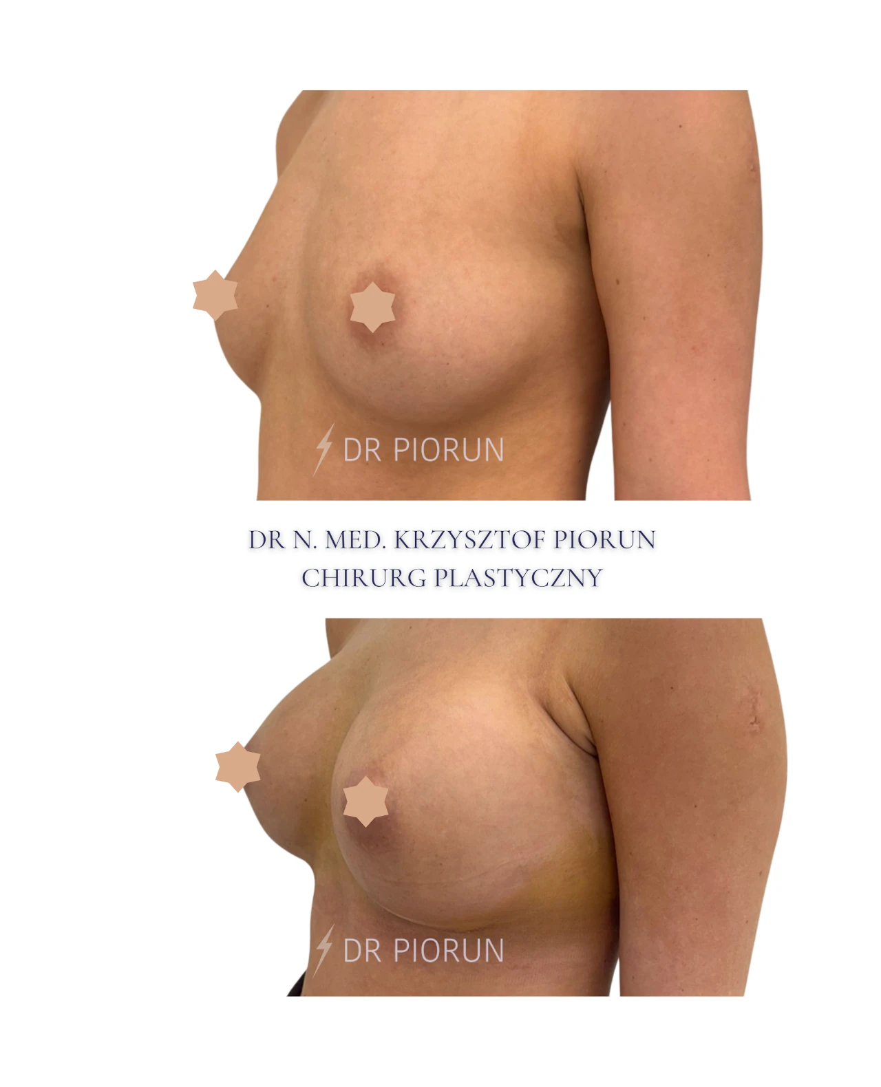 Powiększanie piersi piersi przed zabiegiem i po