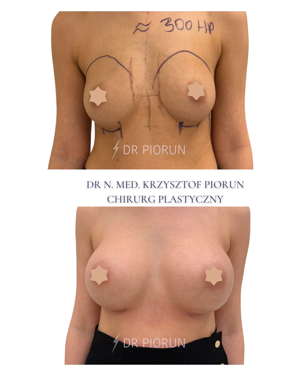 Powiększanie piersi piersi przed zabiegiem i po