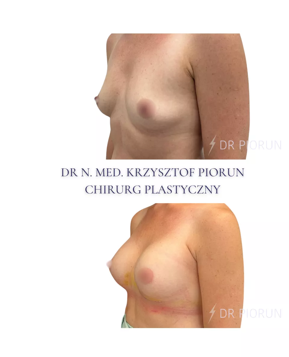 Powiększanie piersi Piersi przed powiększeniem i po