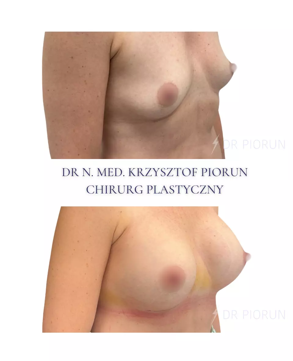 Powiększanie piersi Piersi przed powiększeniem i po