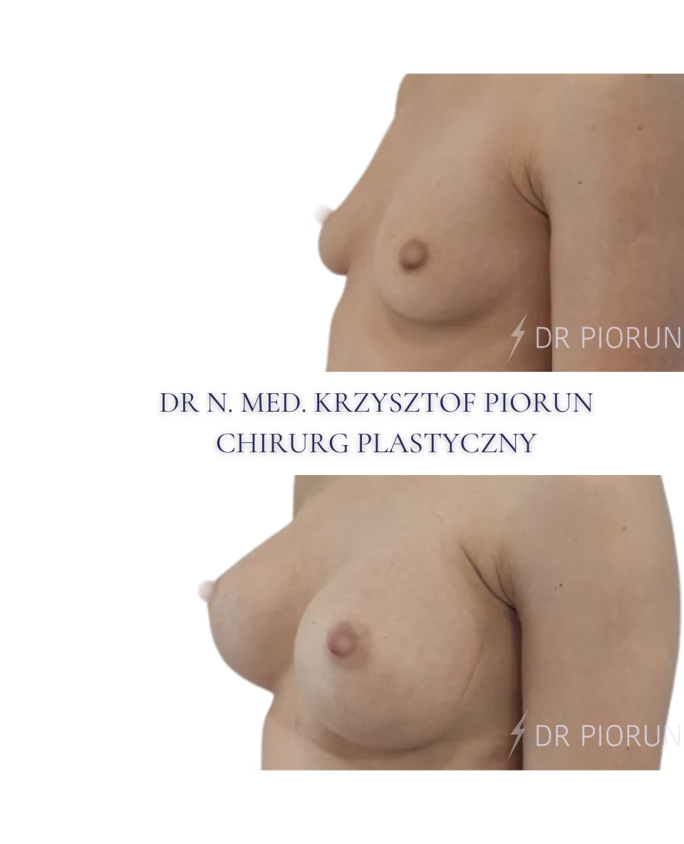 Powiększanie piersi Piersi przed powiększeniem i po