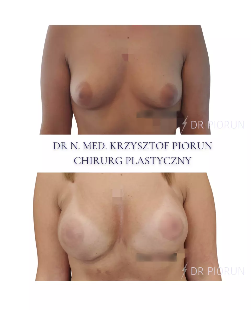 Powiększanie piersi Piersi przed powiększeniem i po