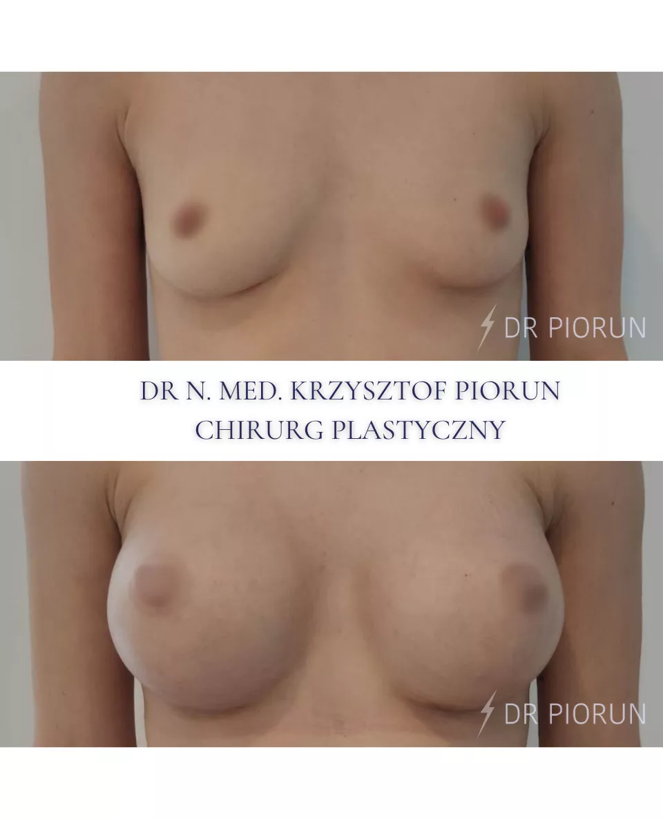 Powiększanie piersi Piersi przed powiększeniem i po