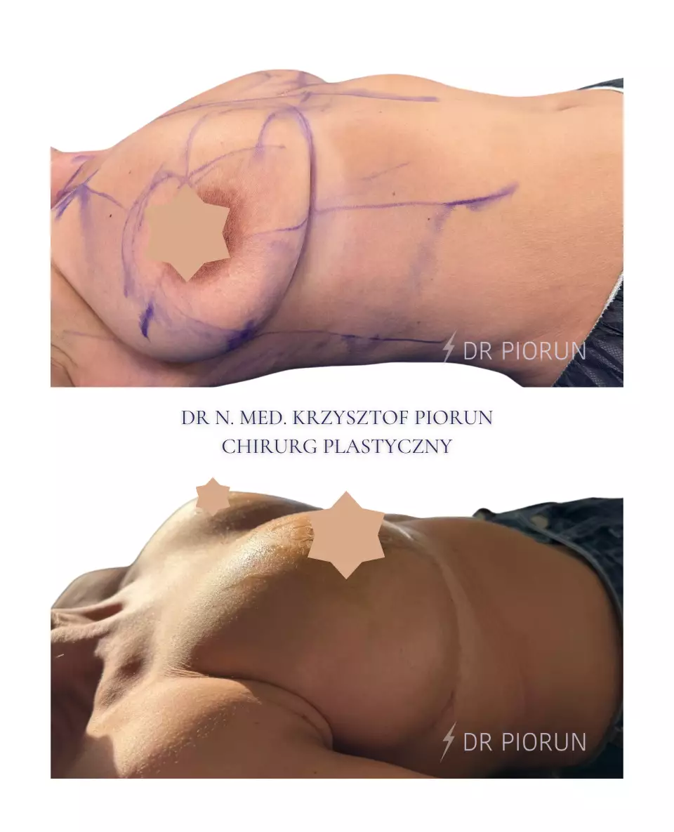 Powiększanie piersi Piersi przed powiększeniem i po