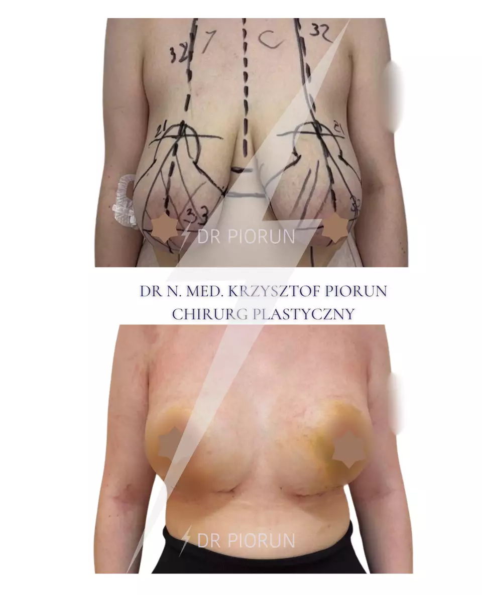 Powiększanie piersi Piersi przed powiększeniem i po