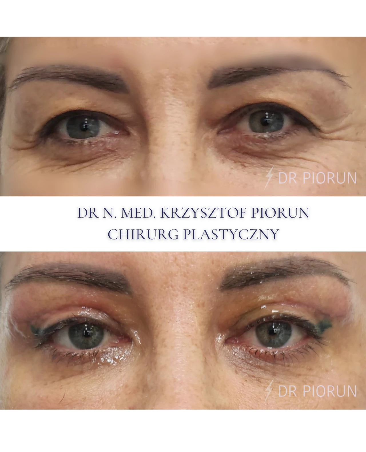 Plastyka powiek górne powieki przed zabiegiem i po