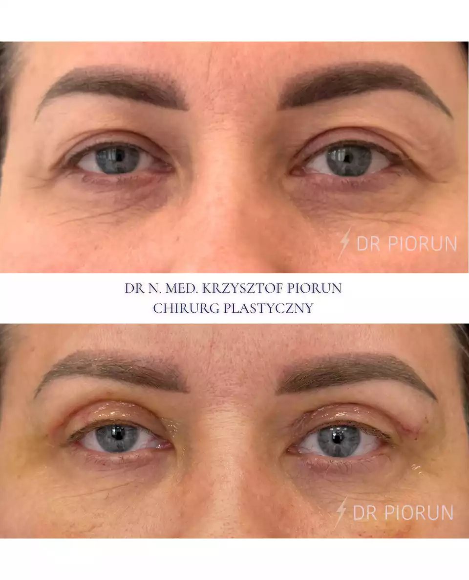 Plastyka powiek powieki przed plastyką i po
