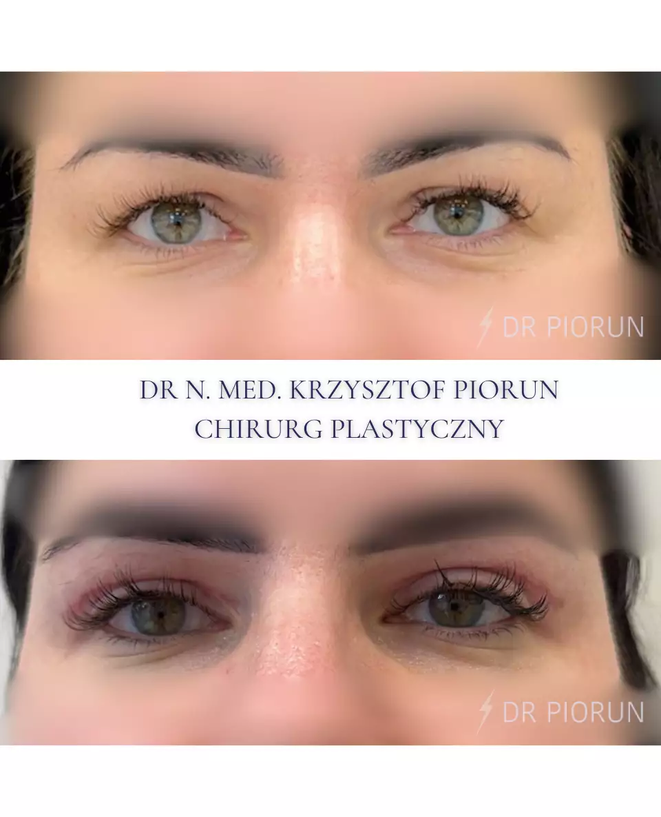 Plastyka powiek powieki przed plastyką i po