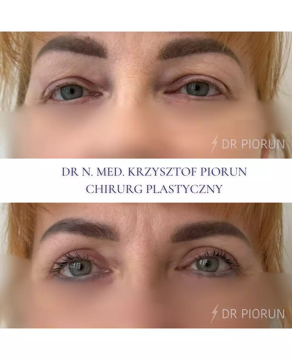 Plastyka powiek powieki przed plastyką i po
