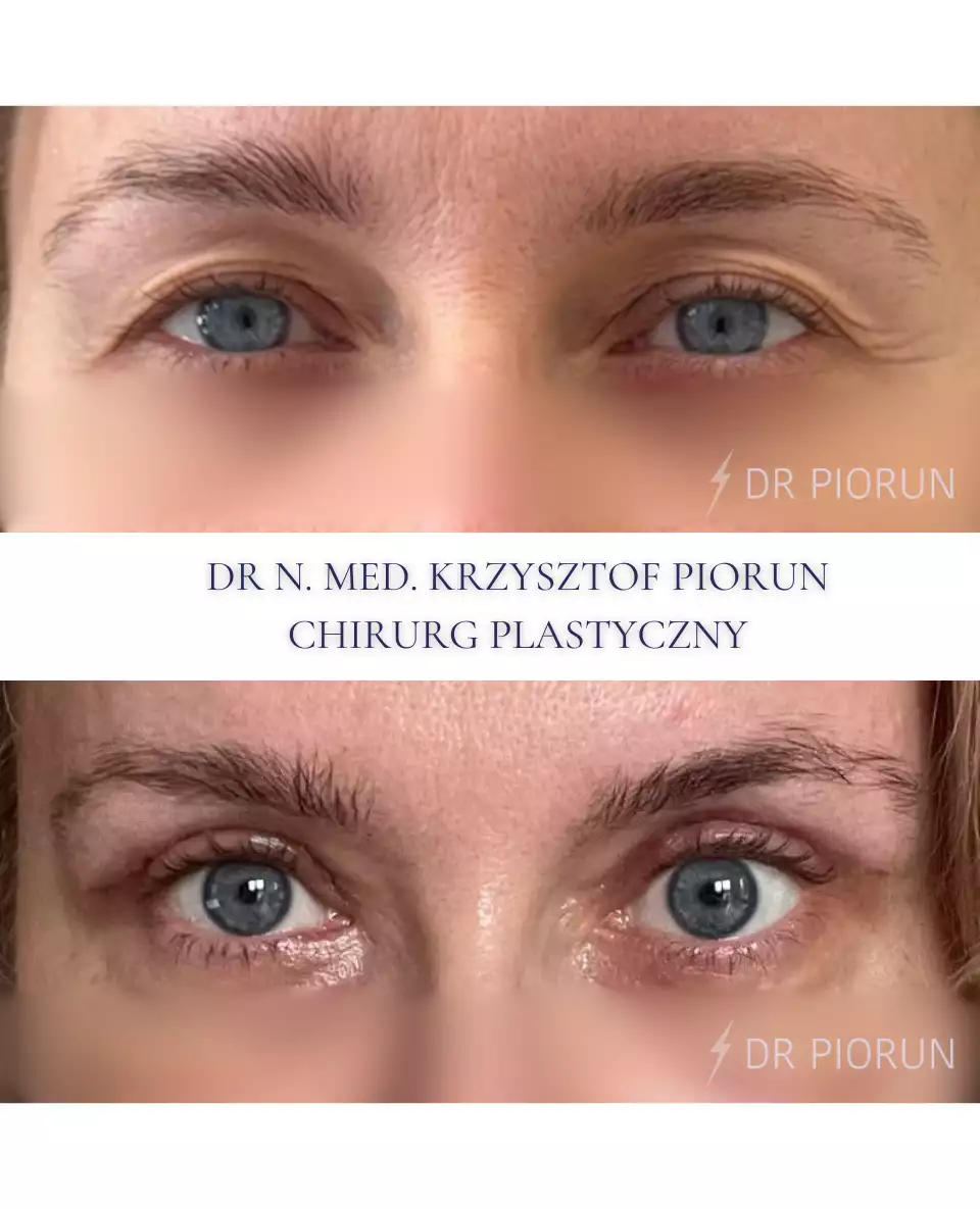 Plastyka powiek powieki przed plastyką i po