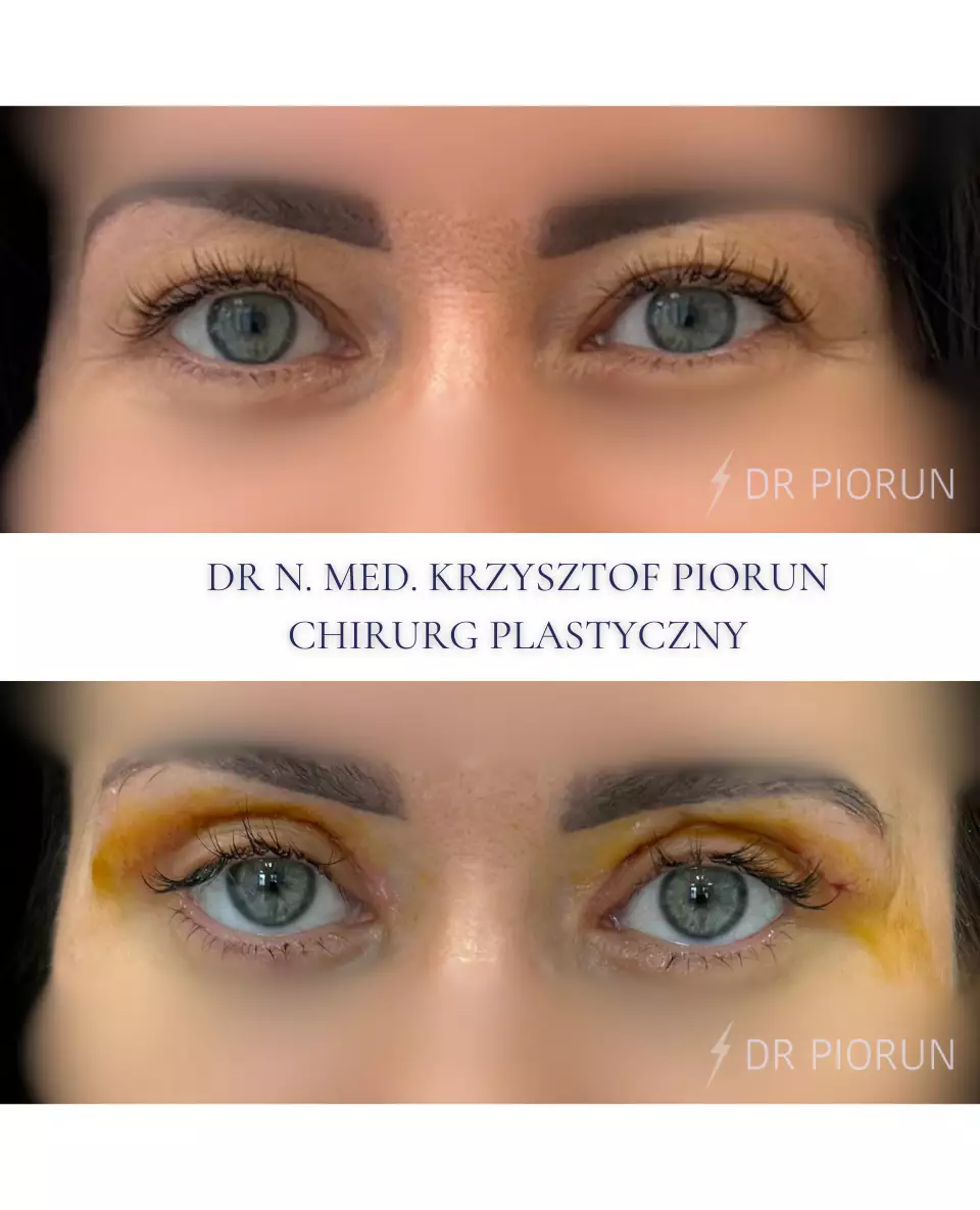 Plastyka powiek powieki przed plastyką i po
