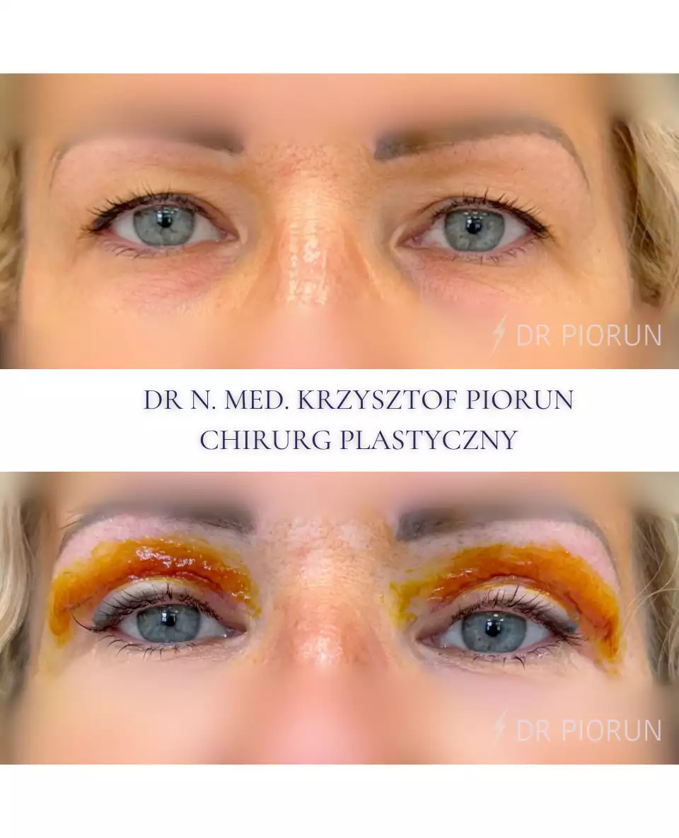 Plastyka powiek powieki przed plastyką i po