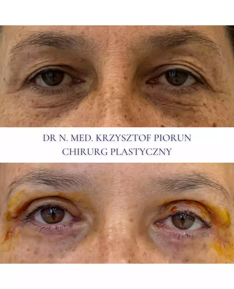 Plastyka powiek powieki przed plastyką i po