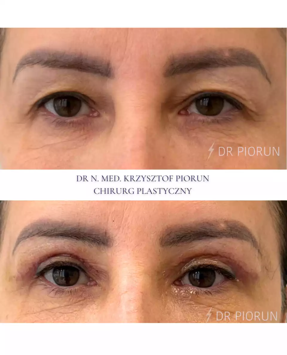 Plastyka powiek powieki przed plastyką i po