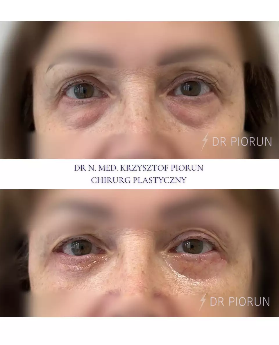 Plastyka powiek powieki przed plastyką i po