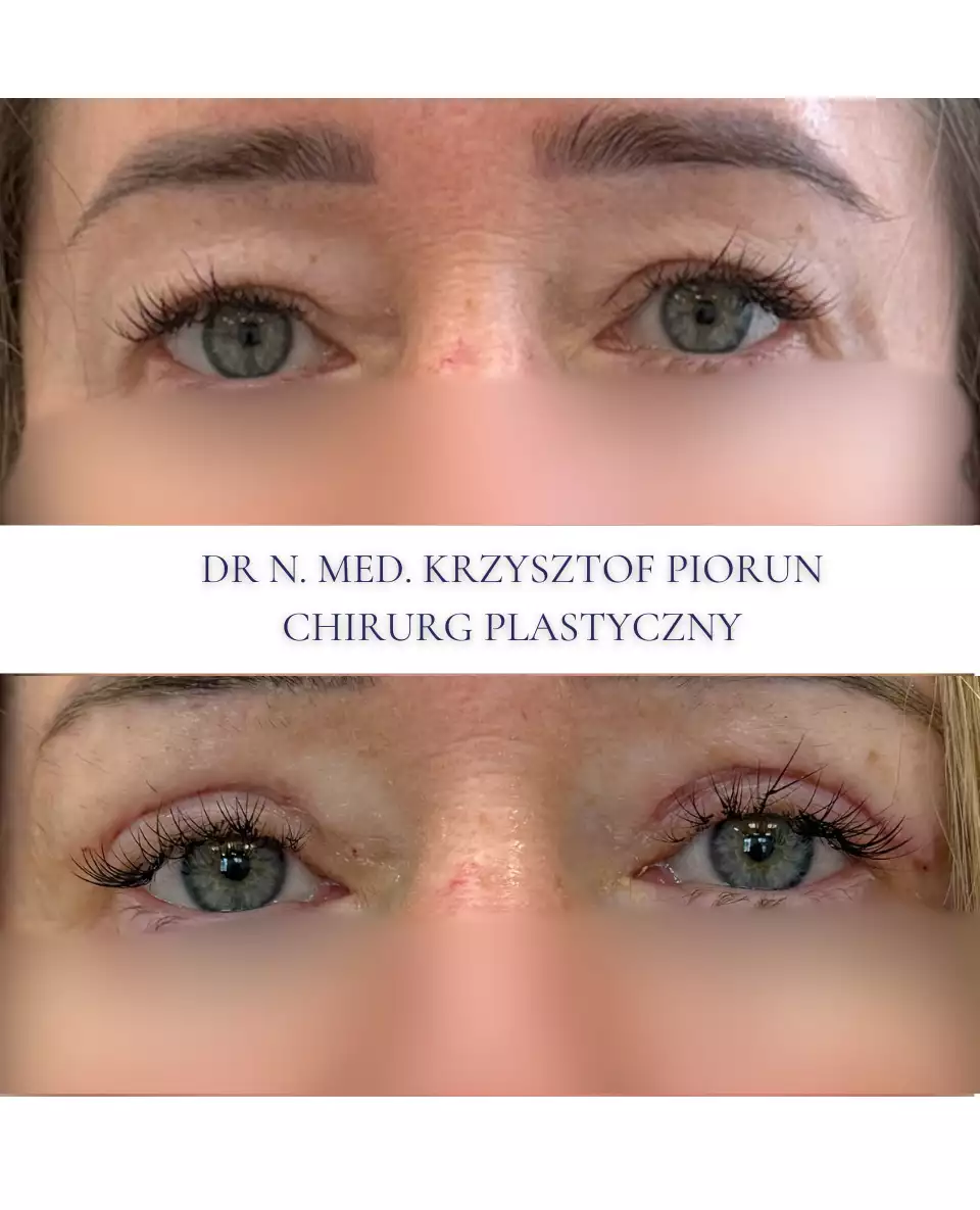 Plastyka powiek powieki przed plastyką i po