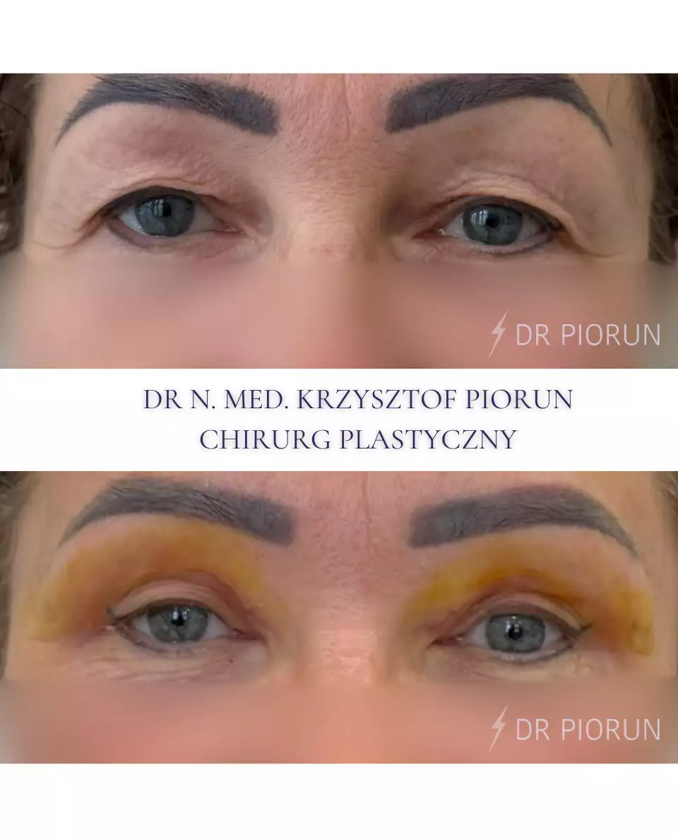 Plastyka powiek powieki przed plastyką i po
