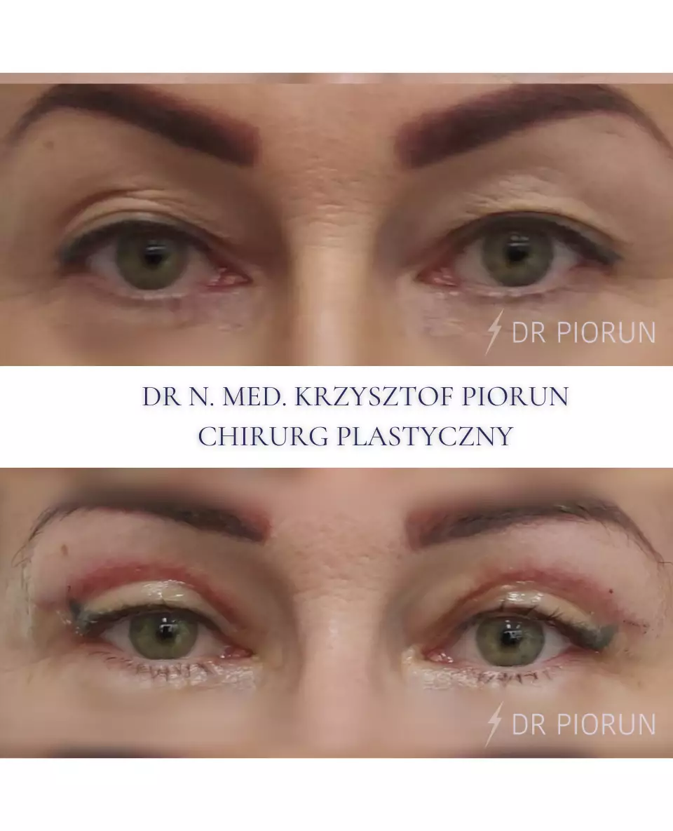 Plastyka powiek powieki przed plastyką i po