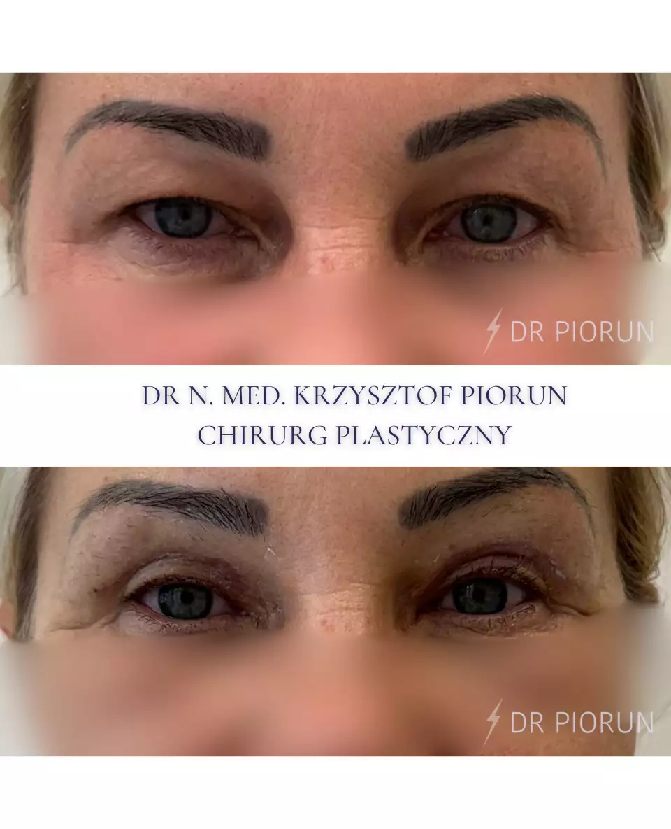 Plastyka powiek powieki przed plastyką i po