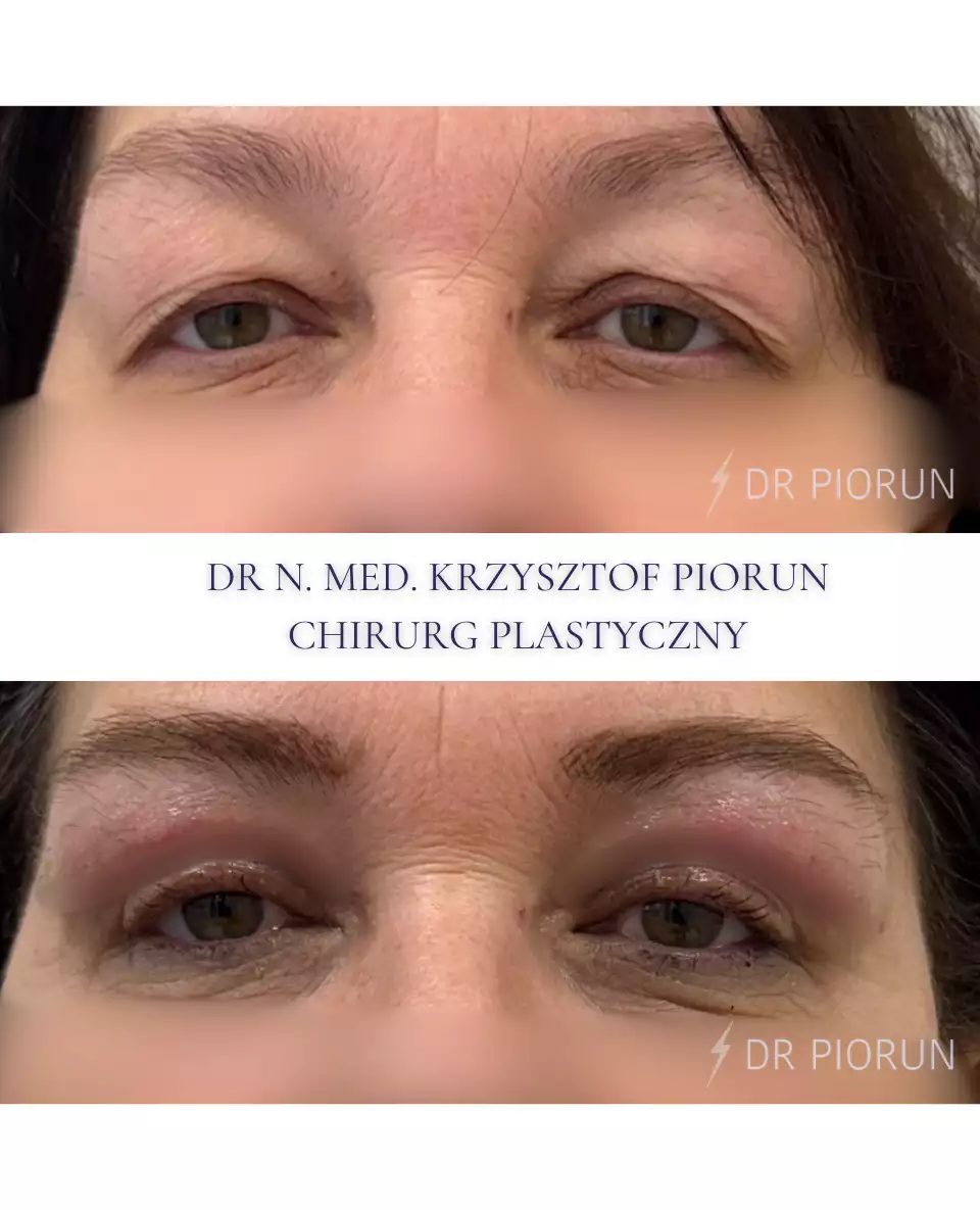 Plastyka powiek powieki przed plastyką i po
