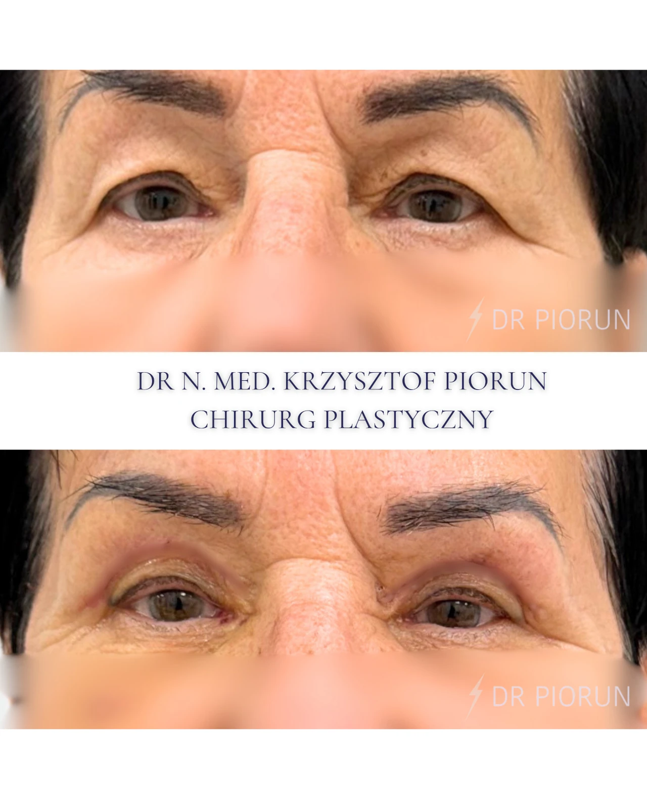 Plastyka powiek górne powieki przed zabiegiem i po