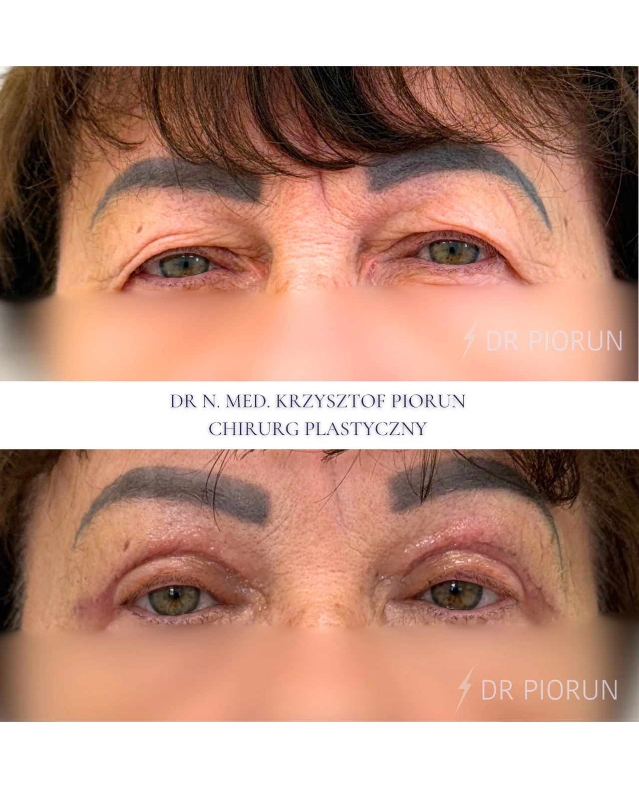 Plastyka powiek górne powieki przed zabiegiem i po