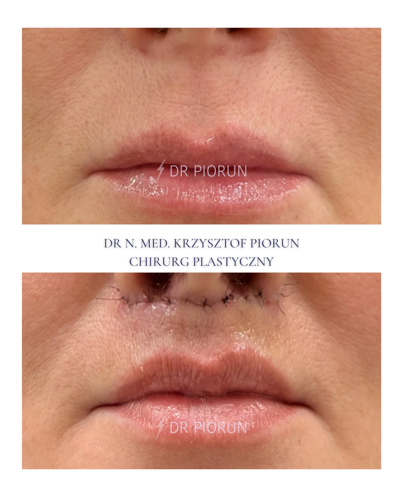 Lifting wargi górnej usta przed zabiegiem i po