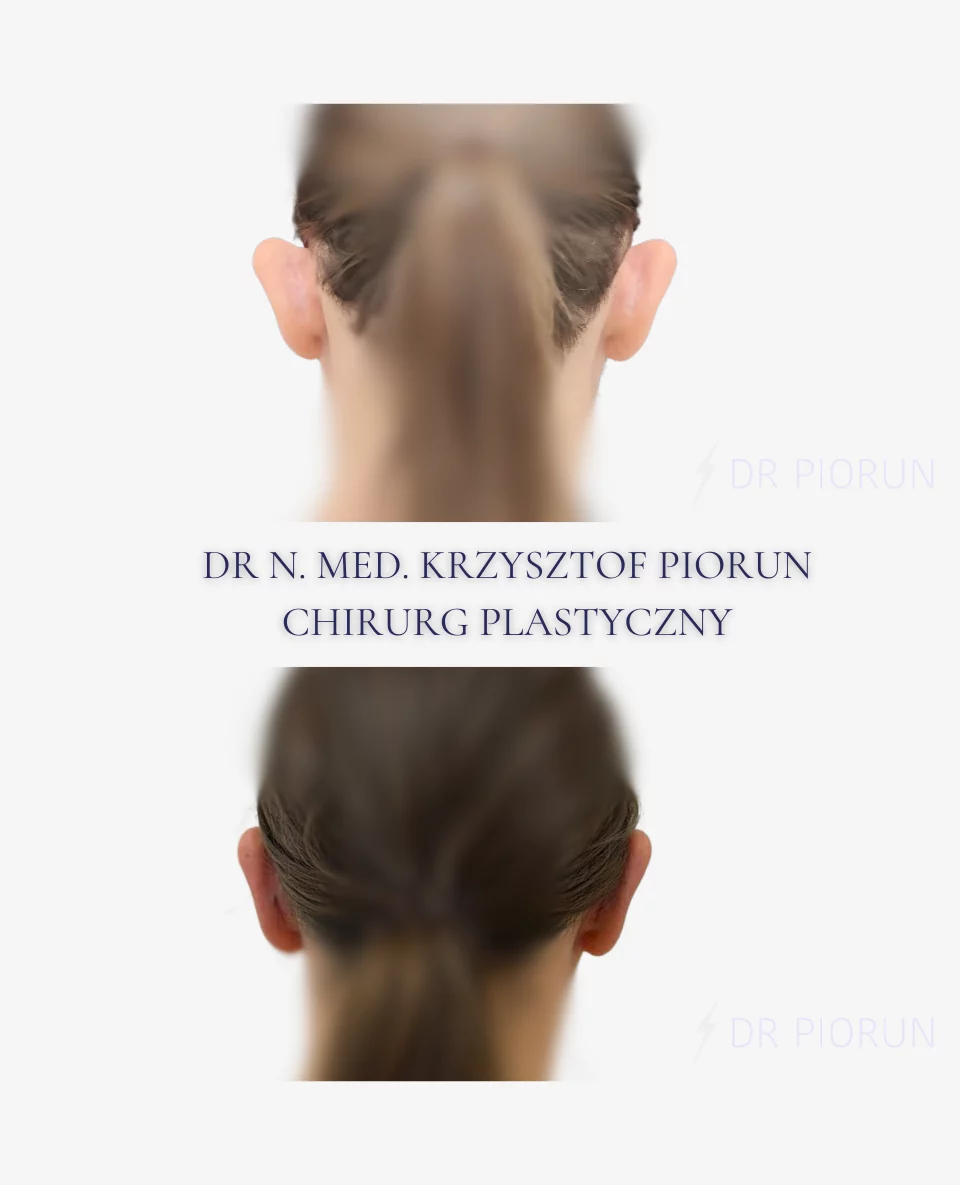 Plastyka uszu Uszy przed plastyką i po