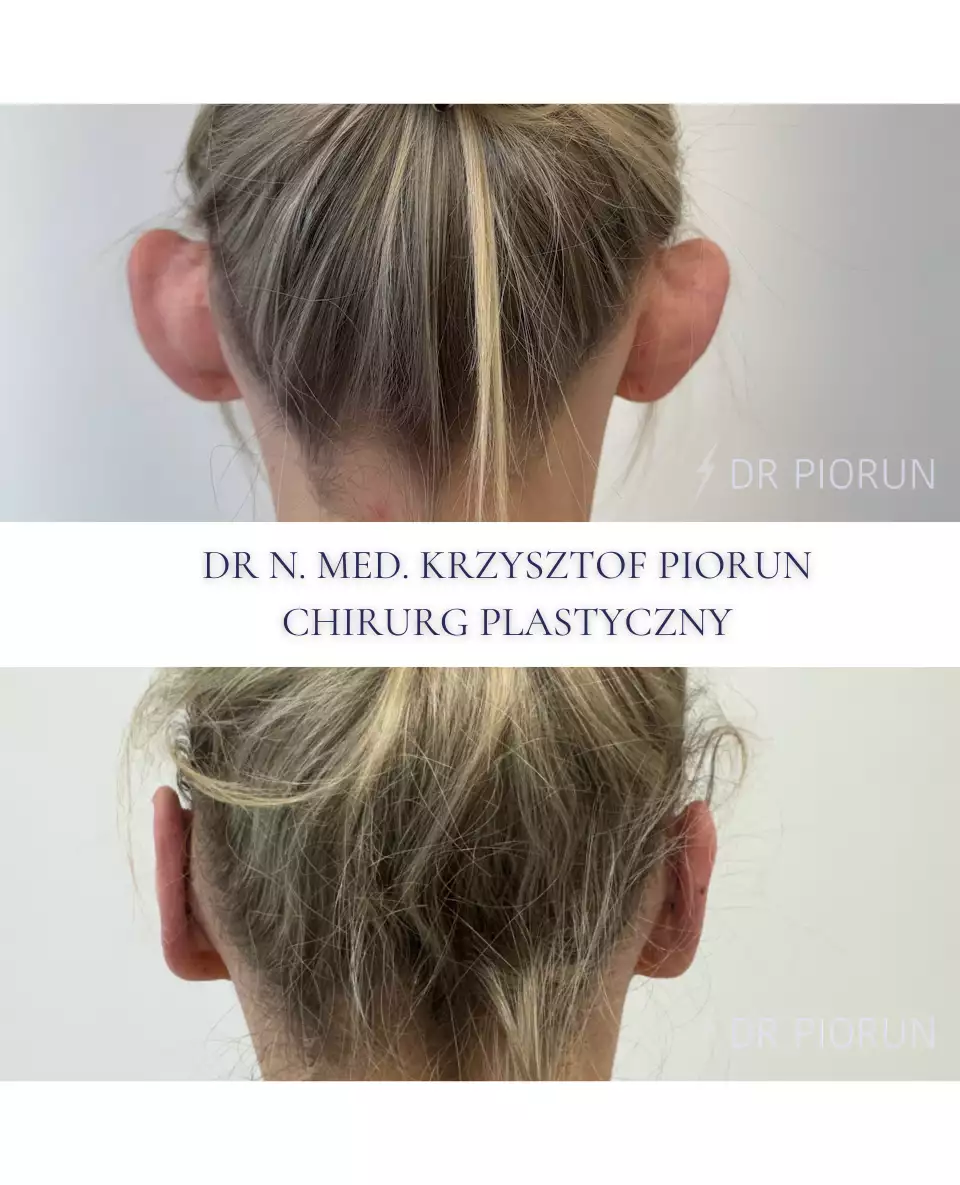 Plastyka uszu Uszy przed plastyką i po