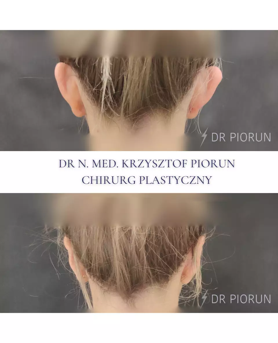 Plastyka uszu Uszy przed plastyką i po
