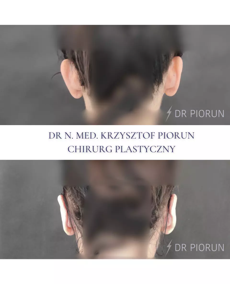 Plastyka uszu Uszy przed plastyką i po
