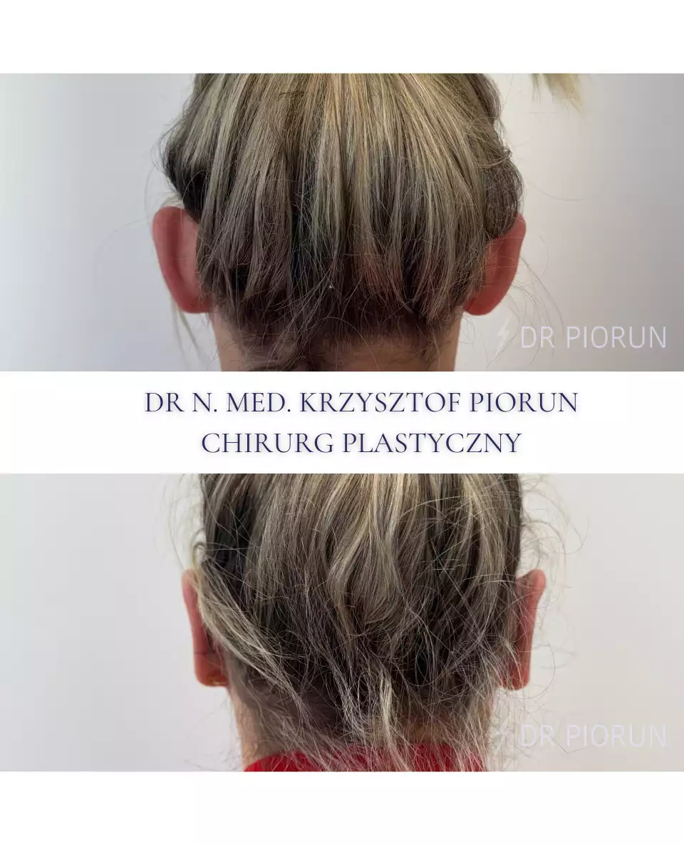 Plastyka uszu Uszy przed plastyką i po