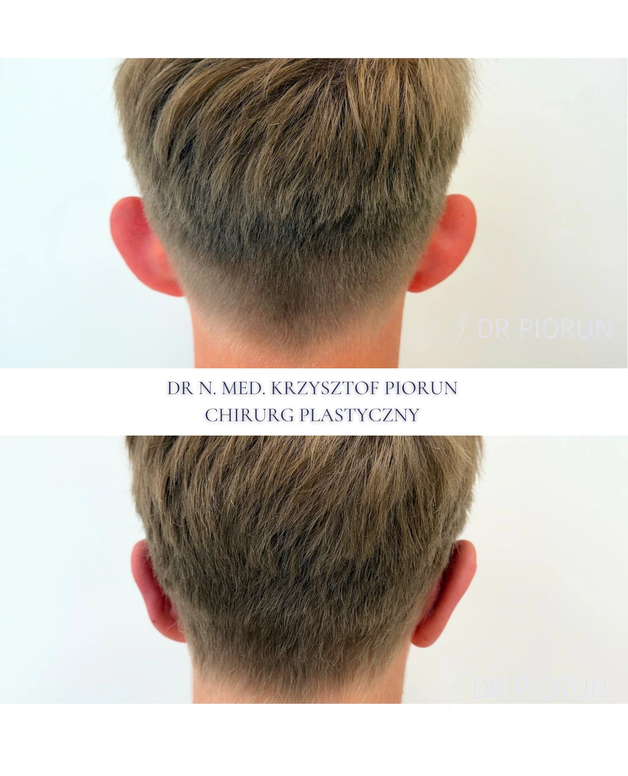 Otoplastyka uszy przed zabiegiem i po