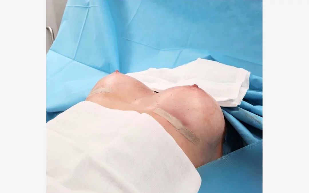 nagie piersi kobiety na stole operacyjnym