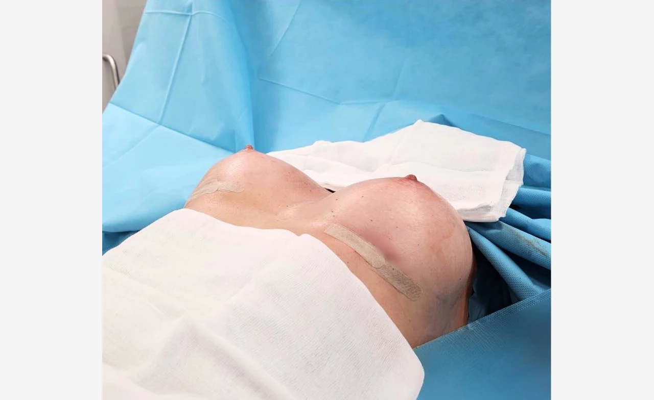 nagie piersi kobiety na stole operacyjnym